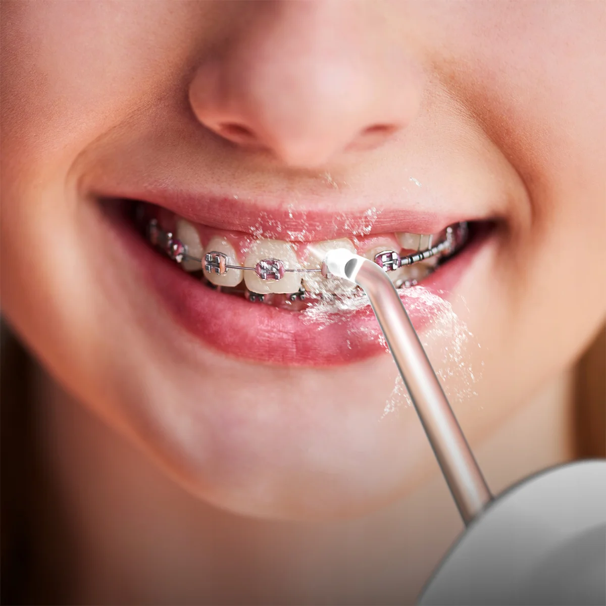 Close-up of braces user cleaning teeth with Grin Teeth WF 1 travel water flosser