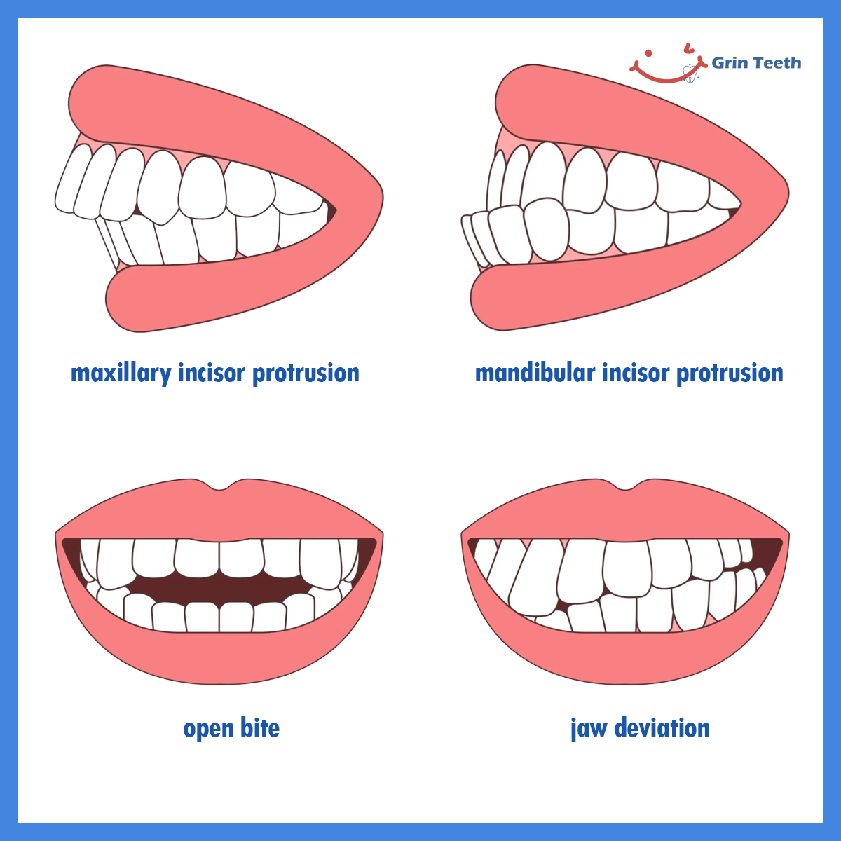 Diagram of dental changes from prolonged thumb sucking in children: incisor protrusion (upper/lower), open bite, and jaw deviation.