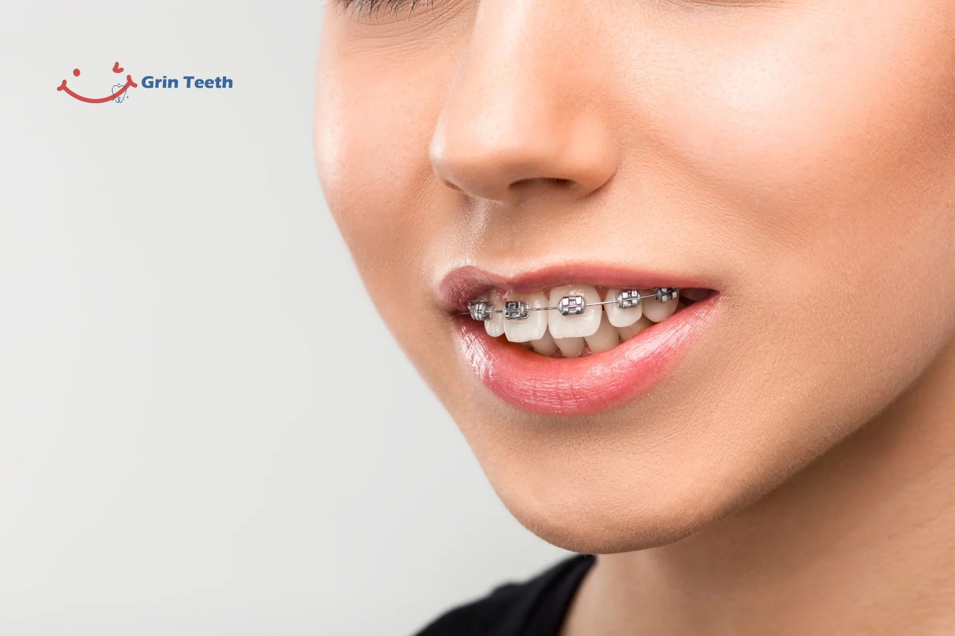 Close-up smile with metal orthodontic braces on upper teeth, showing dental alignment treatment.