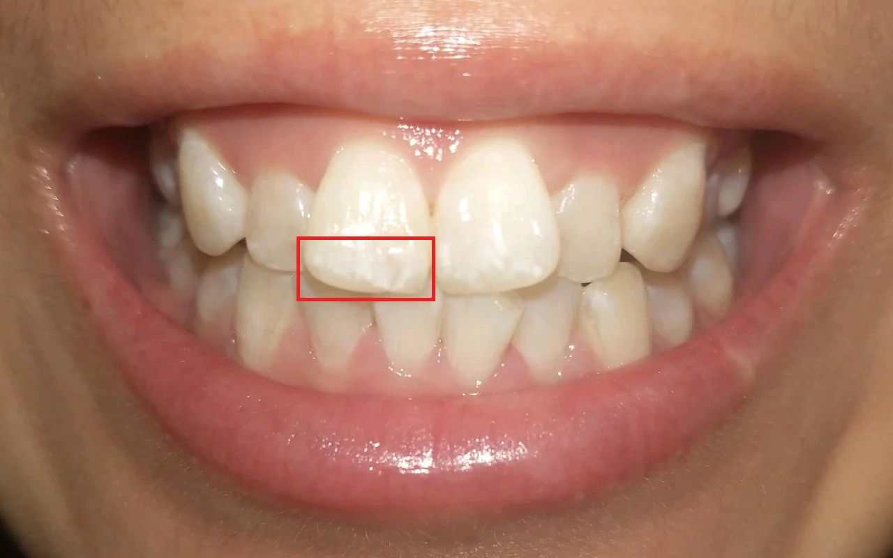 Front tooth with early tooth decay: chalky white spot lesion near the gumline on upper incisors (no cavity yet).
