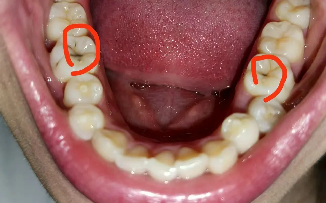Lower molars with tooth decay signs in occlusal fissures—dark lines in deep grooves; assess hardness to tell stain vs cavity.