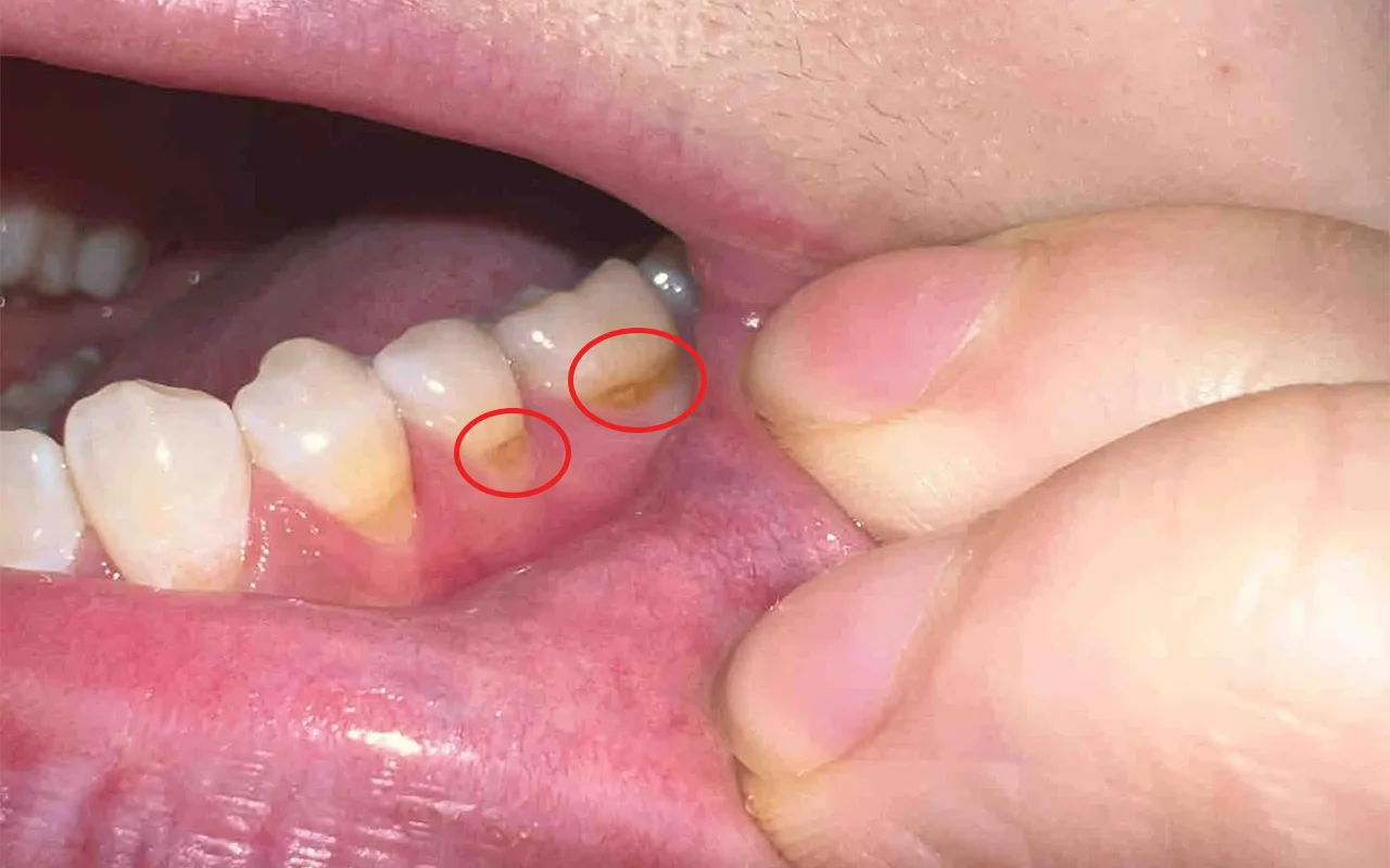 Tooth decay at the gumline on premolars—yellow-brown, softened band indicating cervical/root caries (early lesion).