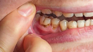 Close-up of lower molars with tooth decay at the gumline; brown/black softened areas (cervical/root caries).