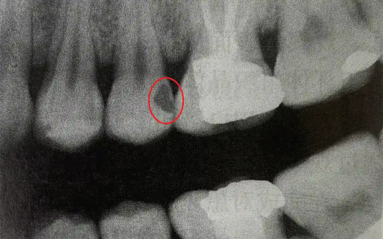Bitewing X-ray showing tooth decay between teeth: triangular radiolucent shadow beneath the contact area (interproximal cavity, E2–D1).